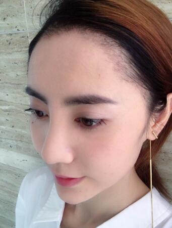 種頭發(fā)有用嗎？種植頭發(fā)恢復(fù)過程真實案例