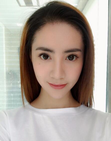 種頭發(fā)有用嗎？種植頭發(fā)恢復(fù)過程真實案例