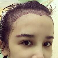 發(fā)際線種植果圖和經(jīng)歷分享——南京明基整形醫(yī)院