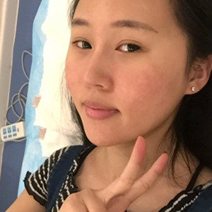 光子嫩膚手術(shù)前后過(guò)程以及對(duì)比照片分享，武漢美都朱紅霞醫(yī)生做的