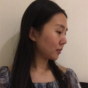 光子嫩膚手術(shù)前后過(guò)程以及對(duì)比照片分享，武漢美都朱紅霞醫(yī)生做的