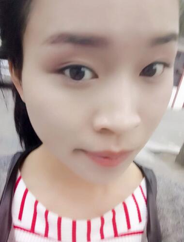 長安醫(yī)院盧丙侖教授V-line瓜子臉手術(shù)前后對(duì)比