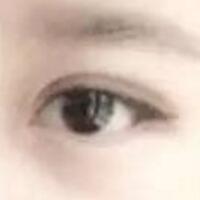 單眼皮變雙眼皮整容日記——廈門安黛美整形醫(yī)院