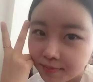 雙眼皮整形前后對比圖，單眼皮變雙眼皮整容日記