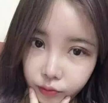 雙眼皮整形前后對比圖，單眼皮變雙眼皮整容日記