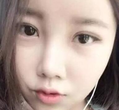 雙眼皮整形前后對比圖，單眼皮變雙眼皮整容日記