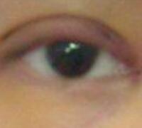 廈門割雙眼皮+開眼角整形過程恢復(fù)對比圖——安黛美整形醫(yī)院