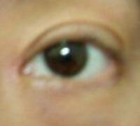 廈門割雙眼皮+開眼角整形過程恢復(fù)對比圖——安黛美整形醫(yī)院