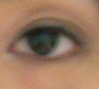 廈門割雙眼皮+開眼角整形過程恢復(fù)對比圖——安黛美整形醫(yī)院