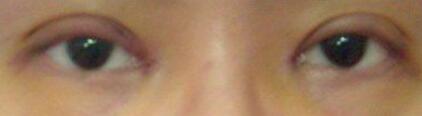 廈門(mén)割雙眼皮+開(kāi)眼角整形過(guò)程恢復(fù)對(duì)比圖