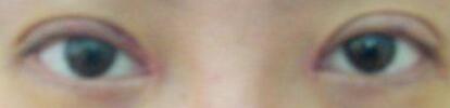 廈門(mén)割雙眼皮+開(kāi)眼角整形過(guò)程恢復(fù)對(duì)比圖