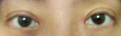 廈門(mén)割雙眼皮+開(kāi)眼角整形過(guò)程恢復(fù)對(duì)比圖