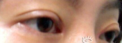 廈門(mén)割雙眼皮+開(kāi)眼角整形過(guò)程恢復(fù)對(duì)比圖