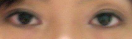 廈門(mén)割雙眼皮+開(kāi)眼角整形過(guò)程恢復(fù)對(duì)比圖