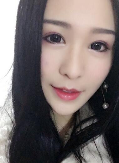 杭州大麥微針龍都整形開眼角+割雙眼皮恢復(fù)記錄