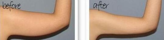 吸脂減肥瘦手臂前后對比圖