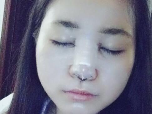 隆鼻整形價格和真實恢復期圖片