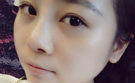 隆鼻整形價格和真實恢復期圖片