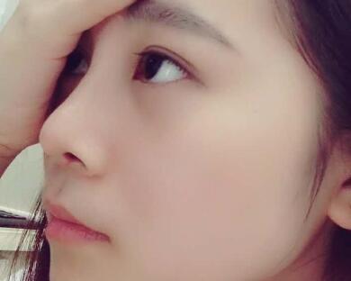 隆鼻整形價格和真實恢復期圖片