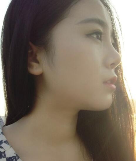 隆鼻整形價格和真實恢復期圖片