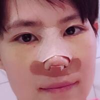 杭州悅可整形醫(yī)院做隆鼻失敗修復(fù)恢復(fù)過程和對(duì)比圖分享