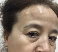 去抬頭紋方法？杭州悅可整容推薦注射瘦臉去抬頭紋魚(yú)尾紋