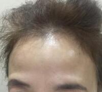 去抬頭紋方法？杭州悅可整容推薦注射瘦臉去抬頭紋魚(yú)尾紋