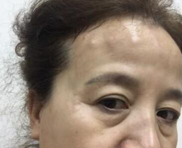 去抬頭紋很好的方法？注射瘦臉去抬頭紋魚尾紋