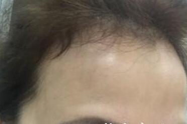 去抬頭紋很好的方法？注射瘦臉去抬頭紋魚尾紋