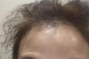 去抬頭紋很好的方法？注射瘦臉去抬頭紋魚尾紋