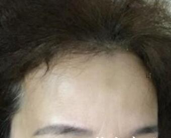 去抬頭紋很好的方法？注射瘦臉去抬頭紋魚尾紋