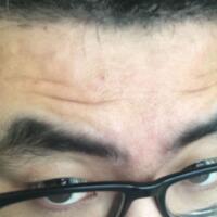 男生注射注射瘦臉去除抬頭紋魚(yú)尾紋案例分享——杭州悅可整形