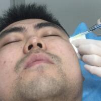 男生注射注射瘦臉去除抬頭紋魚(yú)尾紋案例分享——杭州悅可整形