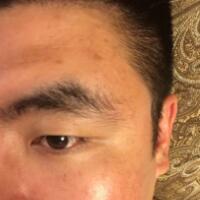 男生注射注射瘦臉去除抬頭紋魚(yú)尾紋案例分享——杭州悅可整形