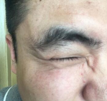 男生注射注射瘦臉去除抬頭紋魚尾紋案例分享