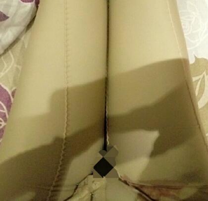 吸脂瘦大腿前后對比圖，水動力吸脂瘦大腿真實案例多對比圖經(jīng)歷