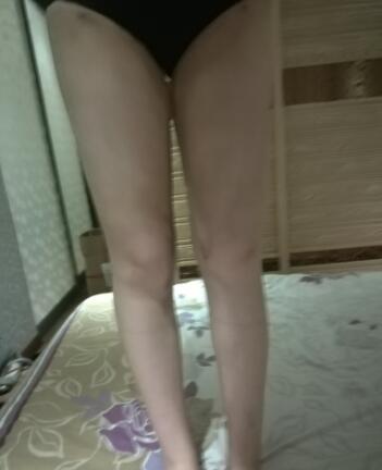 吸脂瘦大腿前后對比圖，水動力吸脂瘦大腿真實案例多對比圖經(jīng)歷