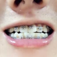 牙齒排列不整齊，在成都圣貝牙科醫(yī)院做了牙齒正畸矯正緩解