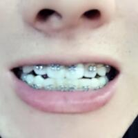 牙齒排列不整齊，在成都圣貝牙科醫(yī)院做了牙齒正畸矯正緩解