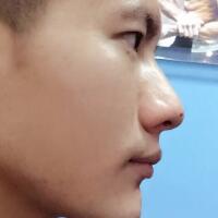 牙齒排列不整齊，在成都圣貝牙科醫(yī)院做了牙齒正畸矯正緩解