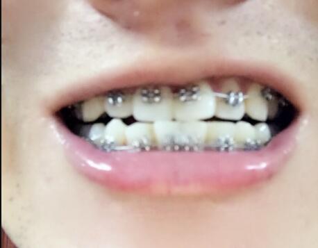在成都圣貝牙科醫(yī)院做了牙齒正畸矯正緩解