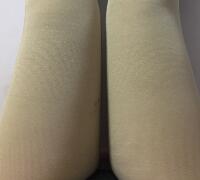 水動(dòng)力吸脂減肥瘦大腿手術(shù)前后對(duì)比圖和恢復(fù)過(guò)程 武漢藝齡整形