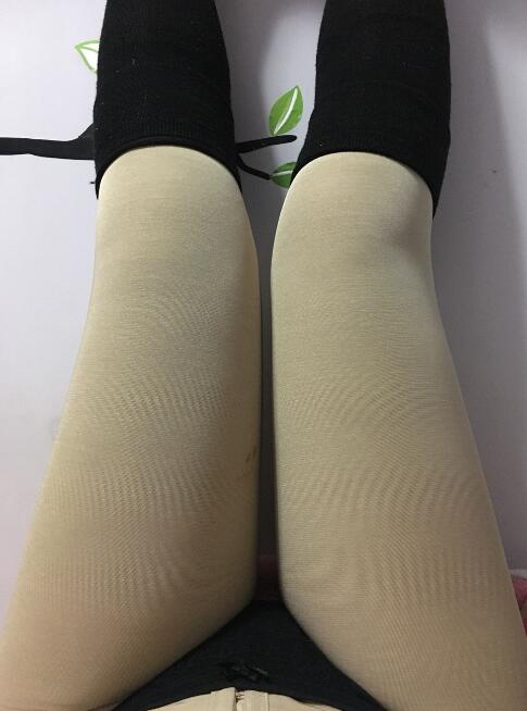 水動(dòng)力吸脂減肥瘦大腿手術(shù)前后對比圖和恢復(fù)過程