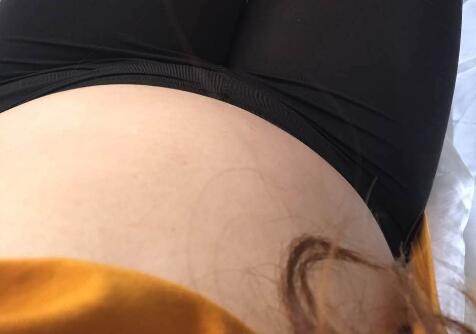 抽脂減肥瘦腰腹手術(shù)價(jià)格1.3w真實(shí)案例前后對(duì)比圖