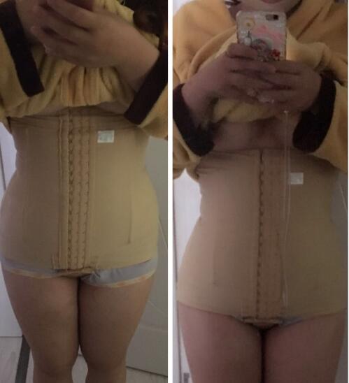 抽脂減肥瘦腰腹手術(shù)價(jià)格，真實(shí)案例前后對(duì)比圖
