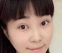 時(shí)光整形醫(yī)院做的割雙眼皮手術(shù)價(jià)格5200元 雙眼皮對比圖恢復(fù)過程