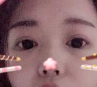 切開雙眼皮+開眼角手術(shù)前后對比圖恢復(fù)過程 昆山時(shí)光整形醫(yī)院