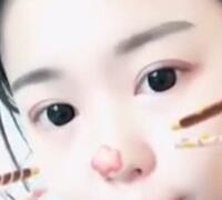 切開雙眼皮+開眼角手術(shù)前后對比圖恢復(fù)過程 昆山時(shí)光整形醫(yī)院