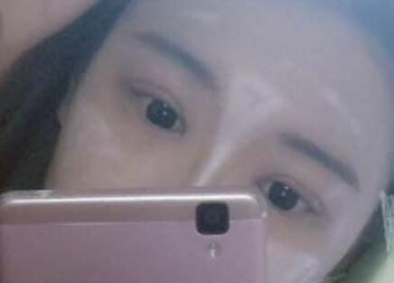 切開雙眼皮+開眼角手術(shù)前后對比圖恢復(fù)過程