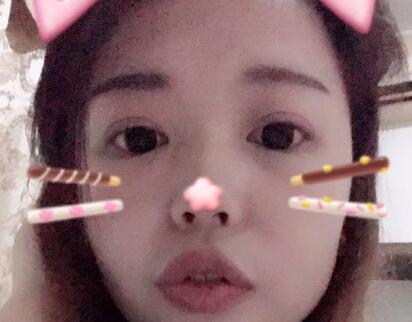 切開雙眼皮+開眼角手術(shù)前后對比圖恢復(fù)過程